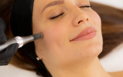 Microneedling & Vampire Facial in Sunderland: The Secret to Naturally Radiant Skin